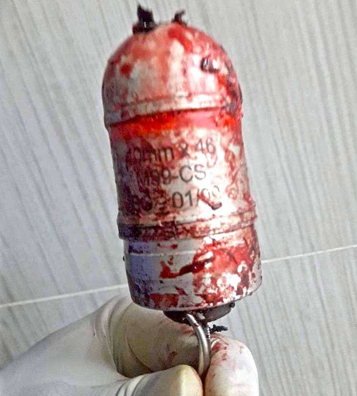 Српска граната М99 извађена из главе ирачког демонстранта [ФОТО]