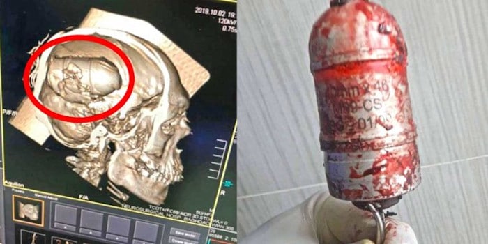 Српска граната М99 извађена из главе ирачког демонстранта [ФОТО]